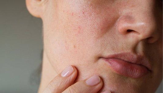 Pelle mista/impura/con acne