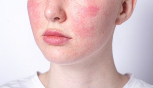 Pelle sensibile/con couperose